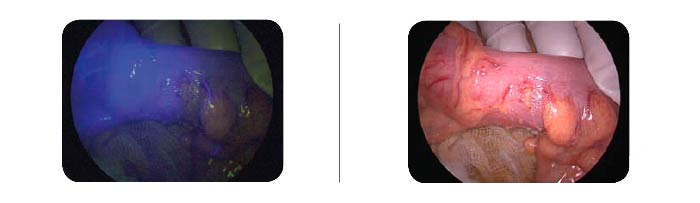Antes e depois - Cirurgia guiada por fluorescência
