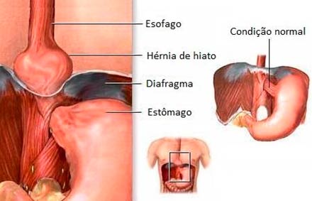 6 passos para recuperação após cirurgia de hérnia de hiato - SBH