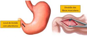 Técnica de piloromiotomia
