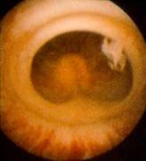 visão endoscópica da válvula uretral posterior