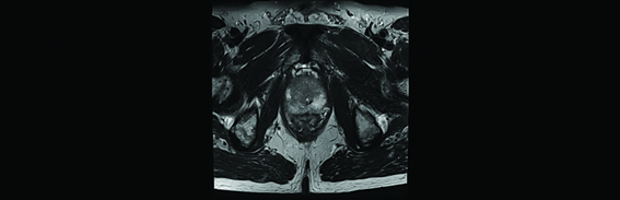 Imagem de RM mostrando uma área de lesão circunscrita suspeita do lado direito da próstata.