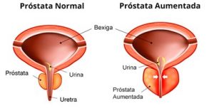 esquema da próstata normal e aumentada