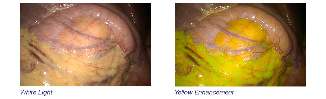 Comparação Yellow Enhancement